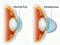 keratoconus