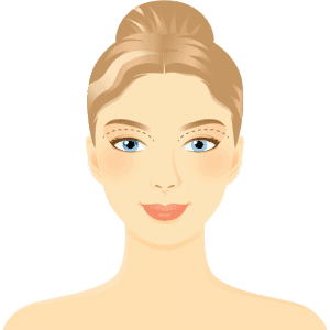 Functional Upper Blepharoplasty